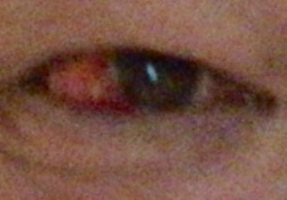 一昨日から左目の目尻に真っ赤になってしまいました。