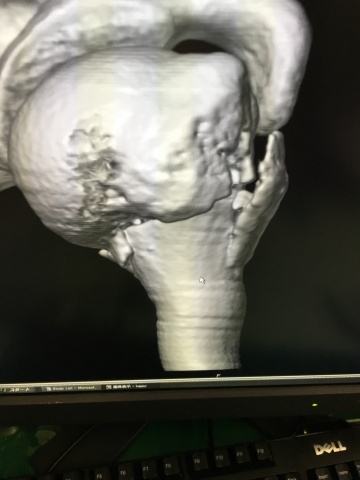 今日CTを撮った所粉砕骨折でした。来週のレントゲンの