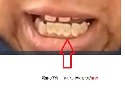 歯垢の証拠写真　です 